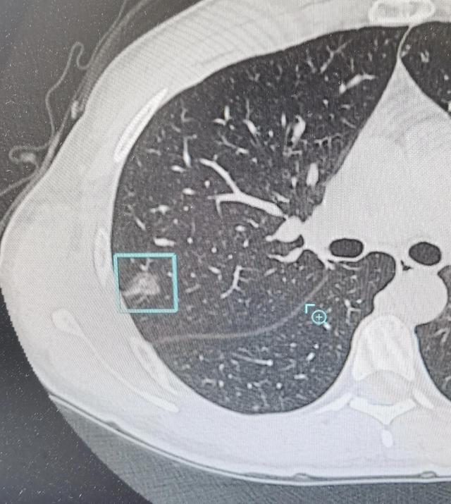 女子肺部磨玻璃结节癌变理赔遭拒，健康保险与医疗纠纷的复杂问题透视