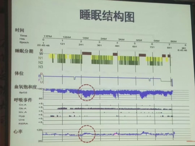 PSG睡眠监测，深入了解你的睡眠状况