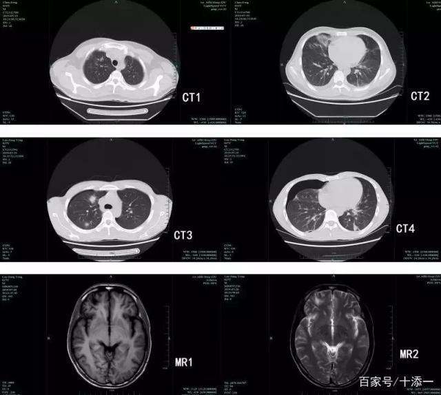 小伙腹泻两周查出感染鬼脸虫，警惕寄生虫病的威胁